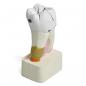 Preview: HeineScientific | Modell kranker Zahn (H139028)