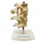Preview: HeineScientific | Osteoporose-Modell (H139060)