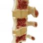 Preview: HeineScientific | Osteoporose-Modell (H139060)