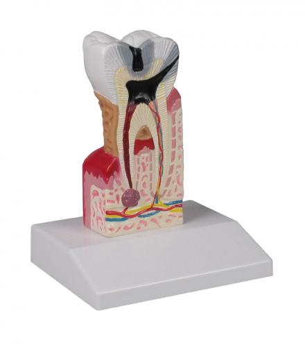 Zahnkariesmodell
