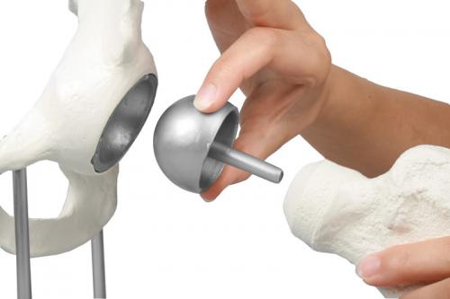 Preview: ERLER-ZIMMER | Hüftgelenk mit Schalenprothese (1118)