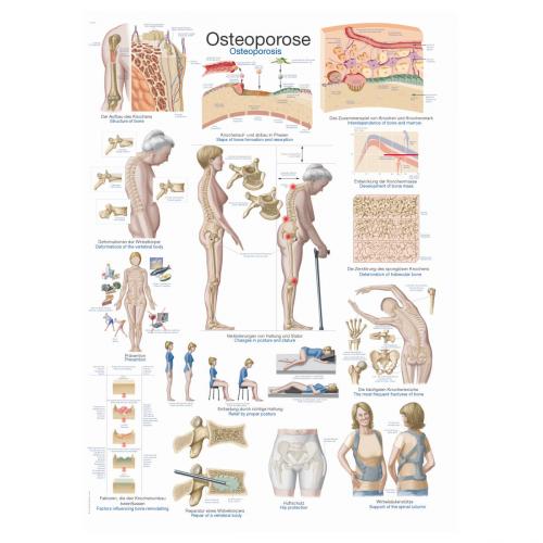 Lehrtafel Osteoporose (50 x 70)
