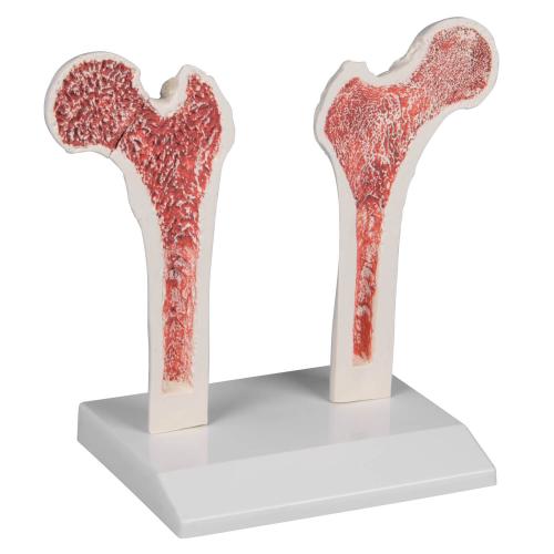 Osteoporose Oberschenkel