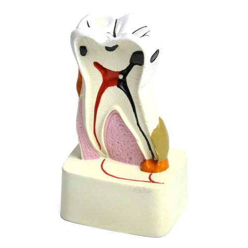 Modell kranker Zahn