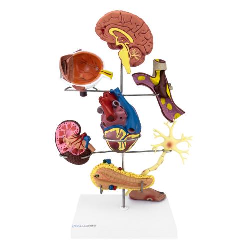 Diabetesmodell mit Folgeerkrankungen