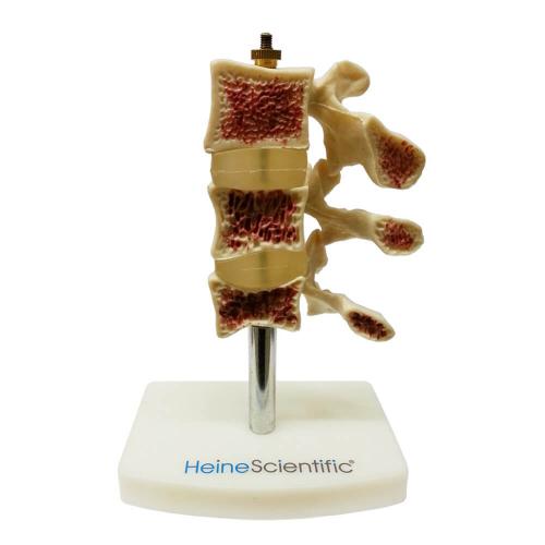 HeineScientific | Osteoporose-Modell (H139060)
