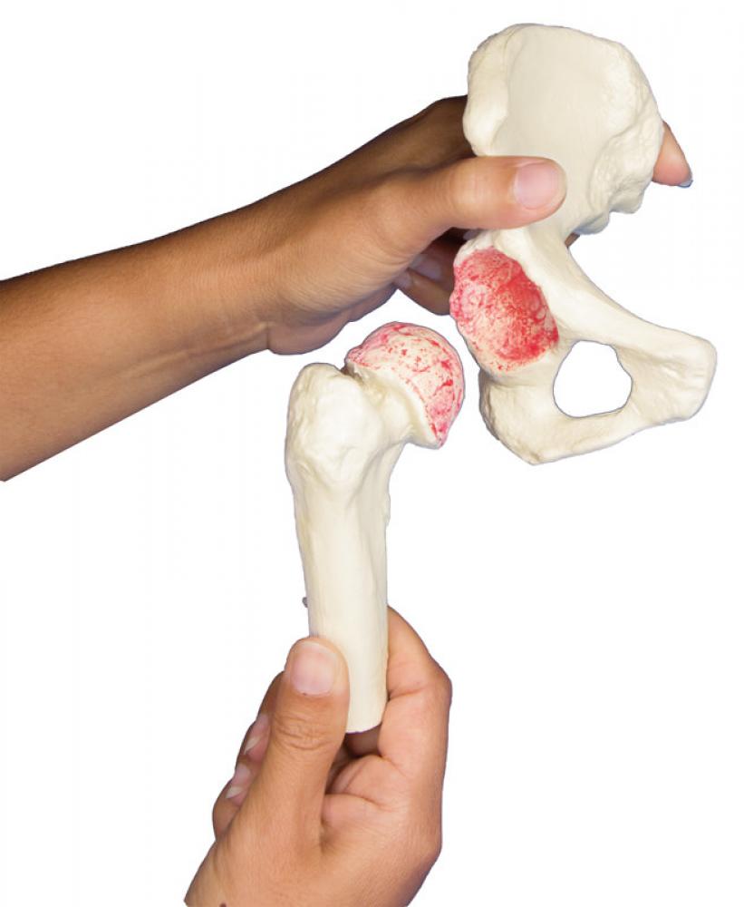 ERLER-ZIMMER | Hüft-Implantat-Modell (1115)