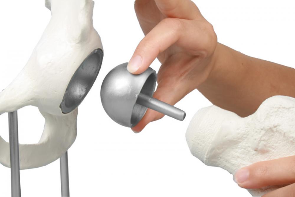 ERLER-ZIMMER | Hüftgelenk mit Schalenprothese (1118)