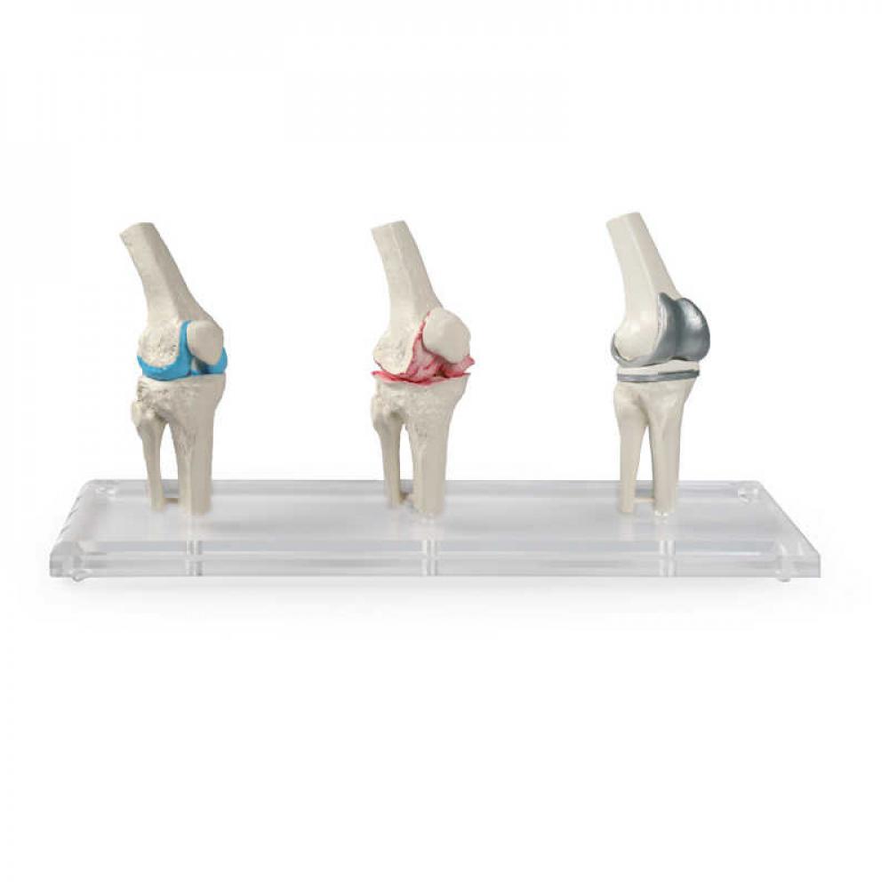 ERLER-ZIMMER | Knie-Implantat-Modell (1125)