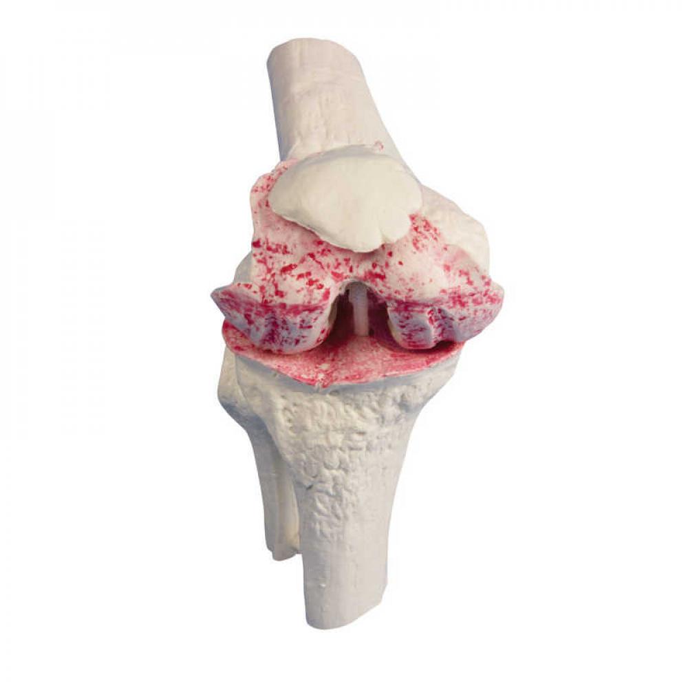 ERLER-ZIMMER | Knie-Implantat-Modell (1125)