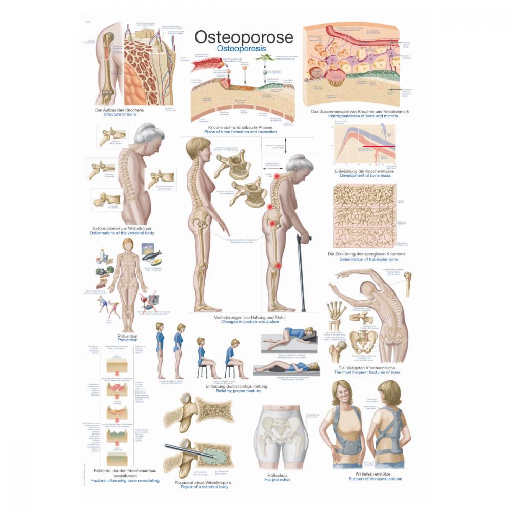 Erler-Zimmer | Lehrtafel Osteoporose (AL504)