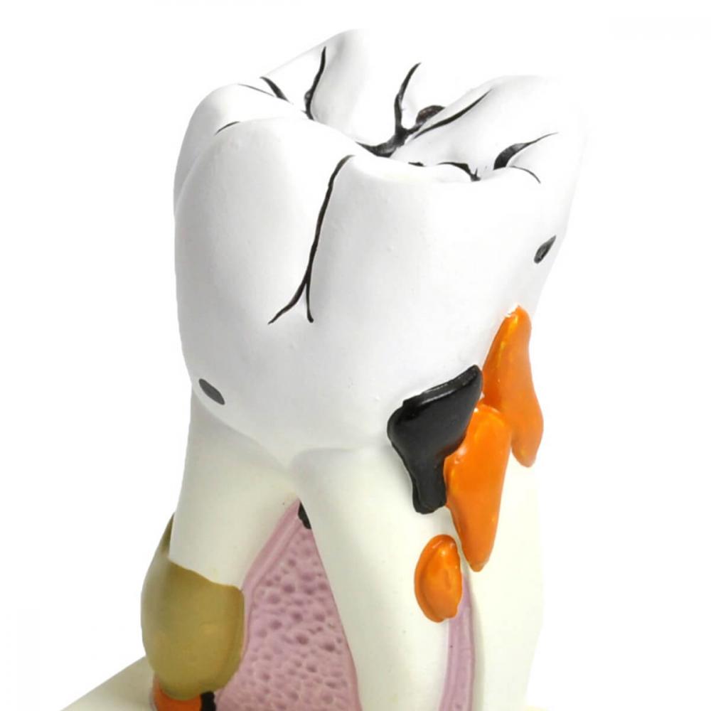 HeineScientific | Modell kranker Zahn (H130889)