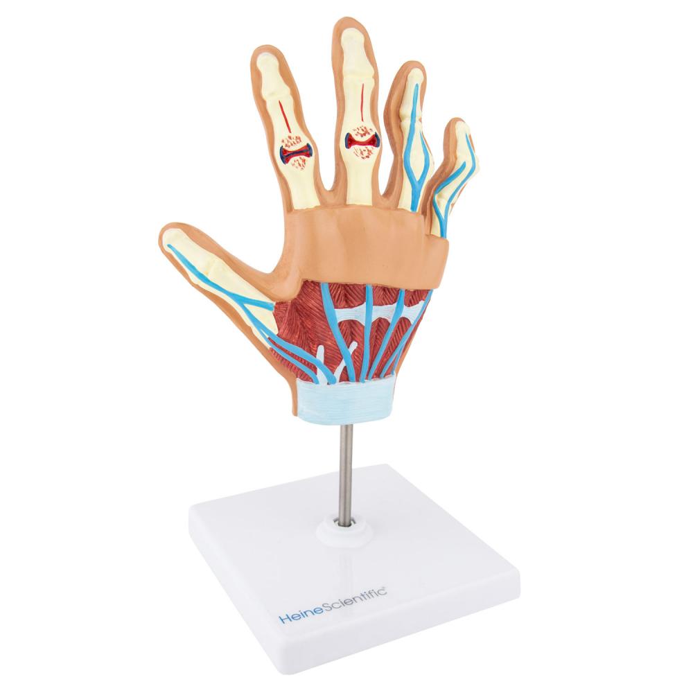 HeineScientific | rheumatoide Arthritis (H139057)