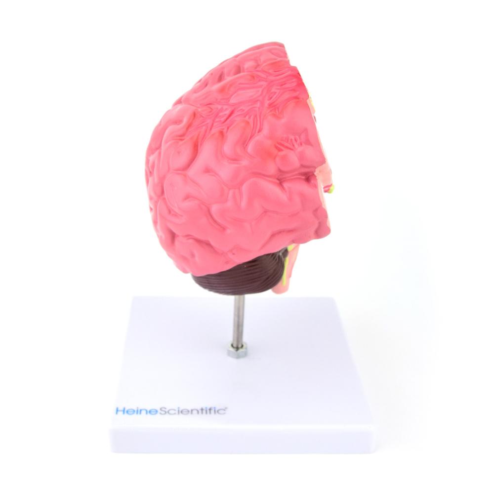 HeineScientific | Gehirn mit Gefäßerkrankungen (H139063)