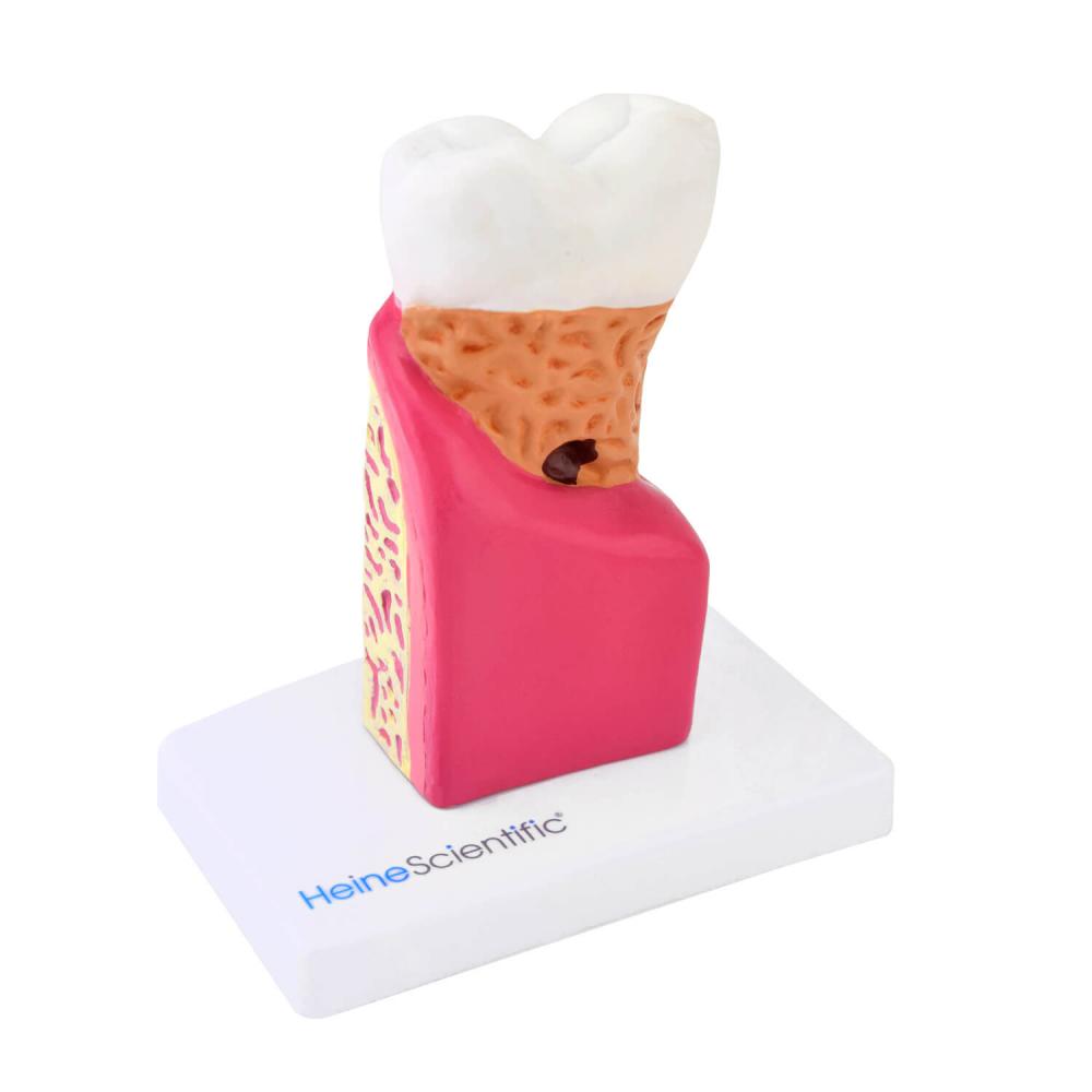 HeineScientific | Modell kranker Zahn (H139028)