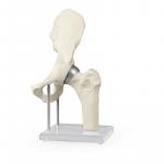 ERLER-ZIMMER | Hüftgelenk mit Schalenprothese (1118)